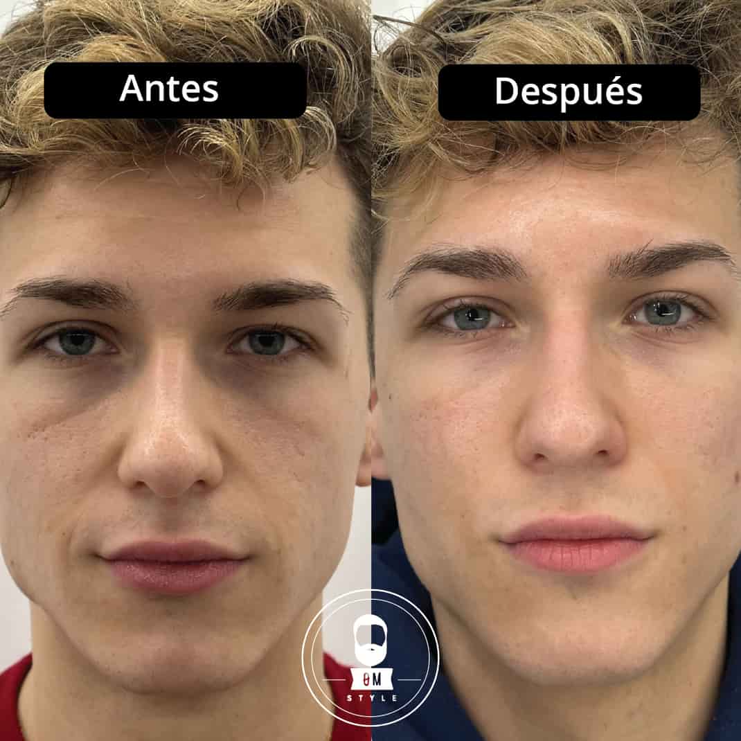 ROLL ON ANTI OJERAS 15ML EN CAJA