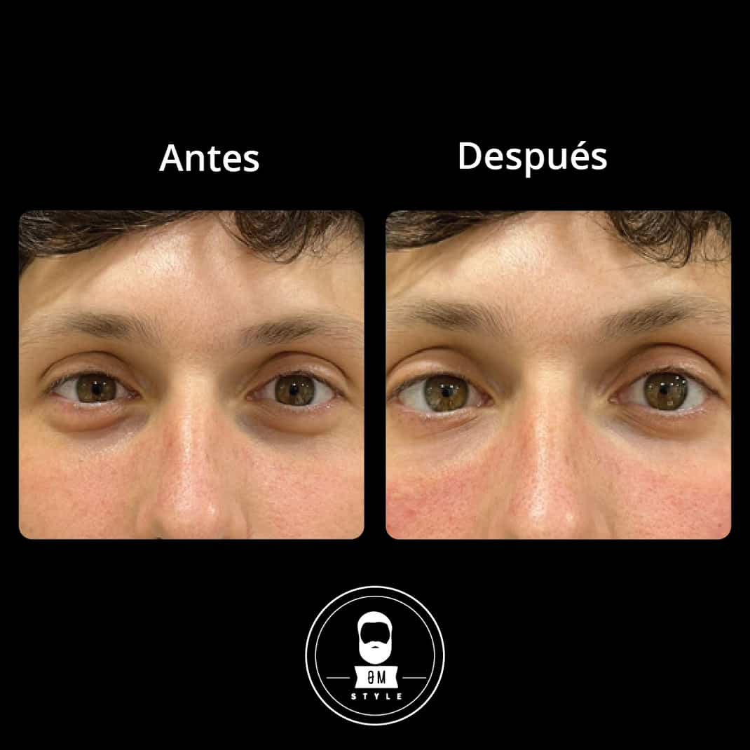 ROLL ON ANTI OJERAS 15ML EN CAJA